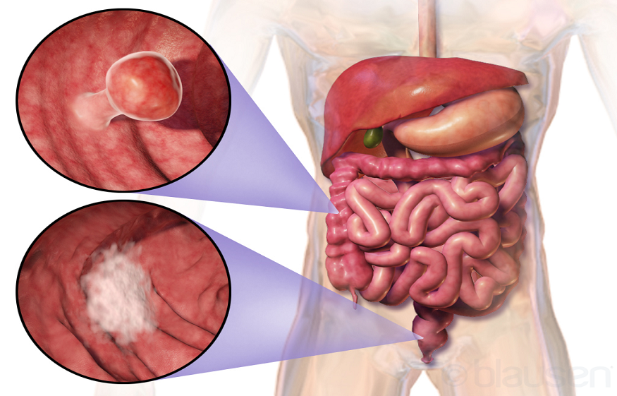 Colorectal cancers