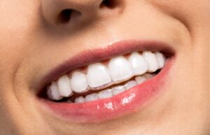 Invisalign for straighter teeth