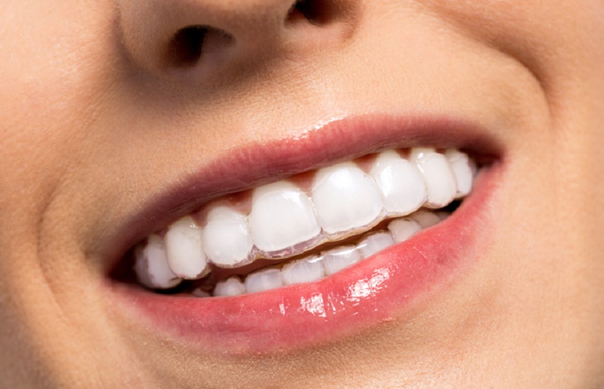 Invisalign for straighter teeth