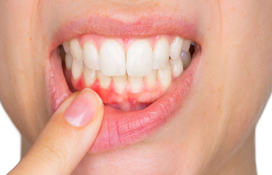 Healthy Gums to Recovery