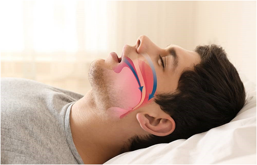 Snoring Surgery