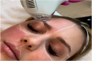 Laser skin treatment